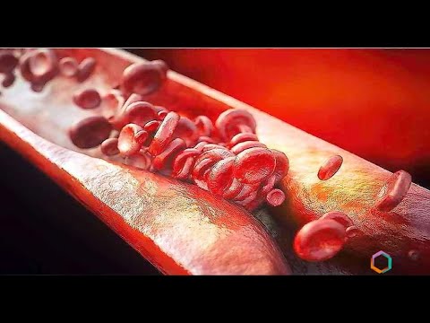 Как меняется один из маркеров атеросклероза